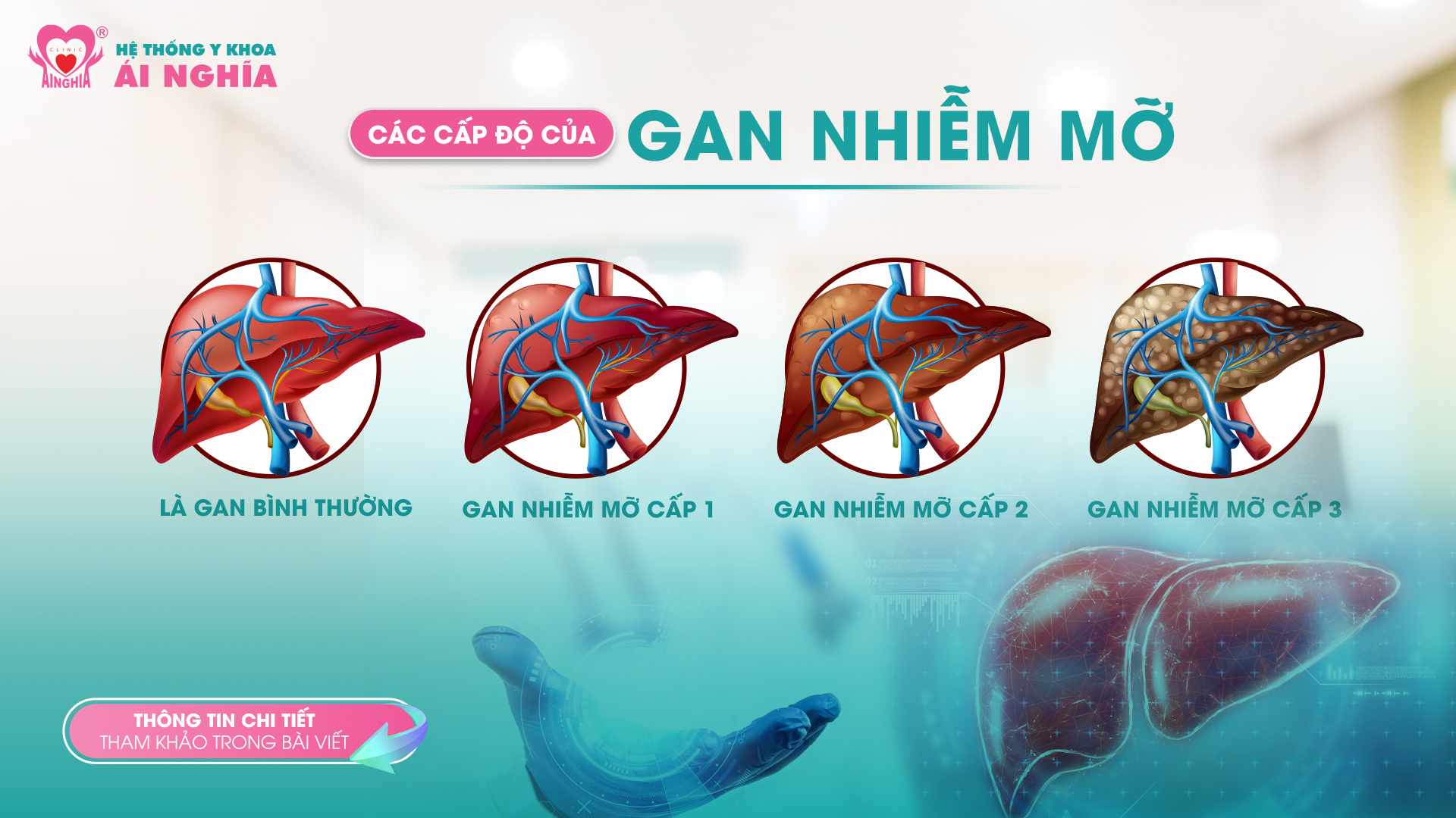 Các cấp độ của gan nhiễm mỡ – nhận biết sớm để bảo vệ lá gan