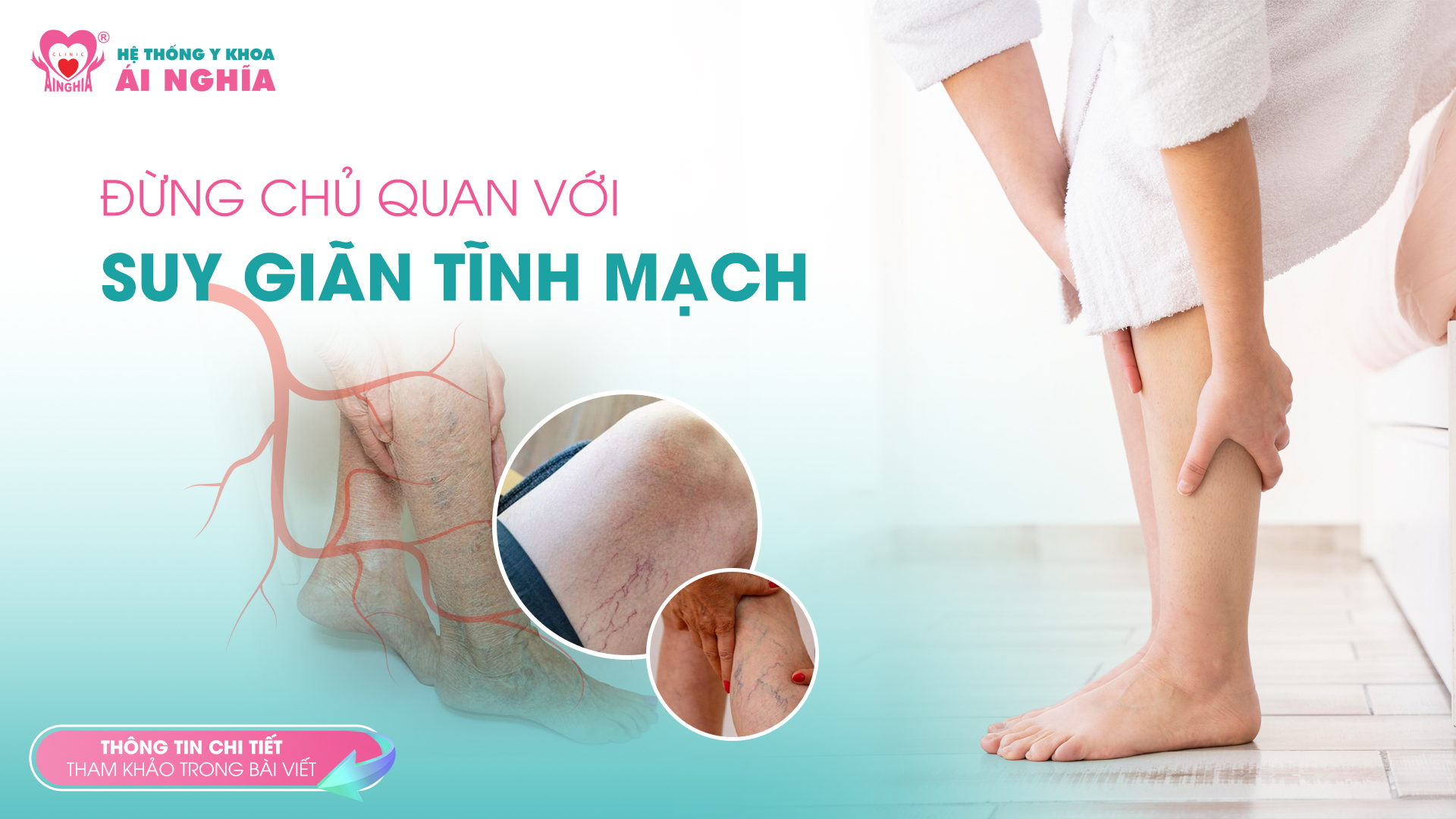 Đừng chủ quan với Giãn tĩnh mạch
