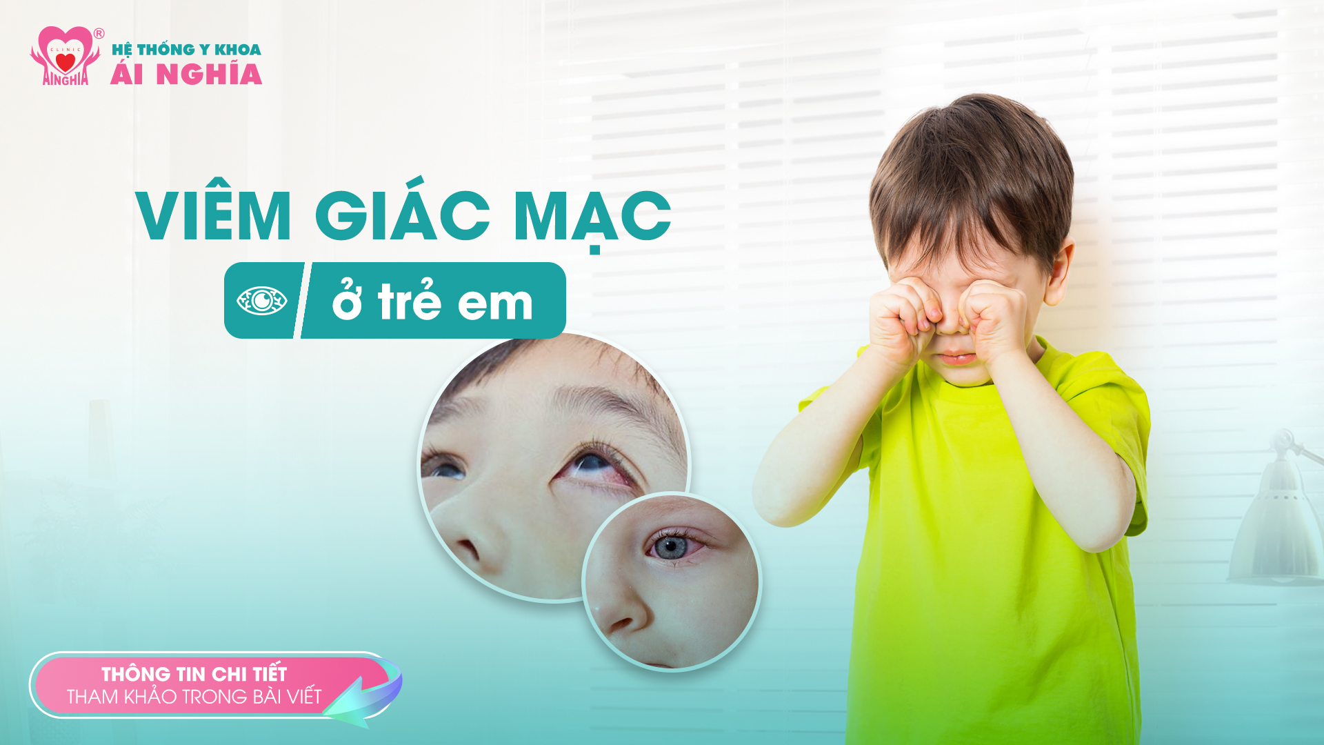 Viêm giác mạc ở trẻ em: dấu hiệu, nguyên nhân và cách phòng ngừa
